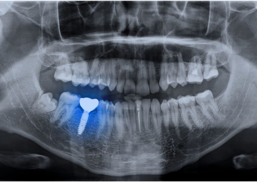 Signos de fallo o rechazo de un implante dental